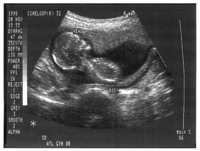 Ultrasound lores